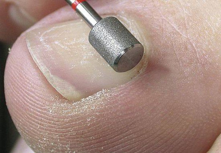 Fraise diamant - Abrasion des ongles - 5,5 mm - 840S/8840S - SIDE Grip 